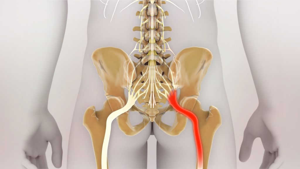 exercises to avoid with Tarlov cysts