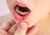 Home Remedies To Cure Mouth Ulcers Naturally: Lessen Your Discomfort home remedies to cure mouth ulcers naturally